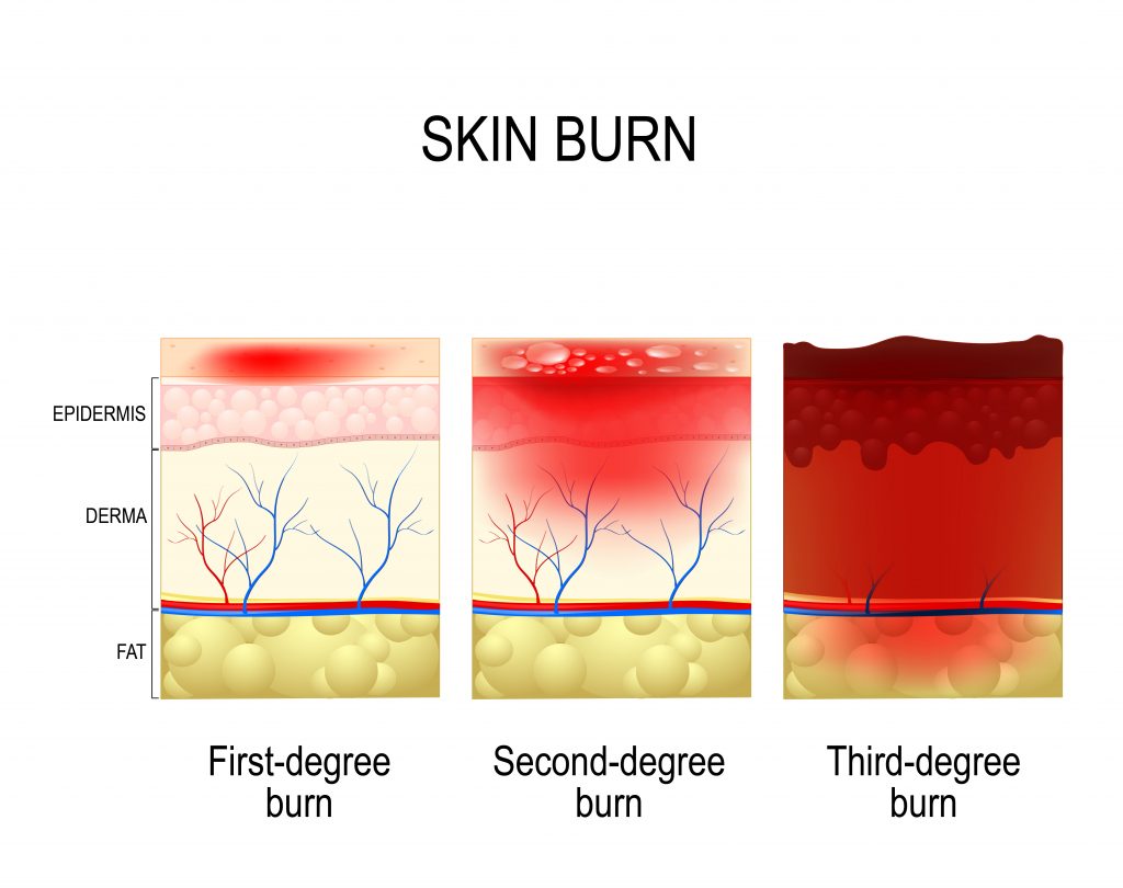fourth degree burn healing time